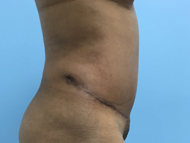 Tummy Tuck Before & After Gallery - Patient 120905402 - Image 6