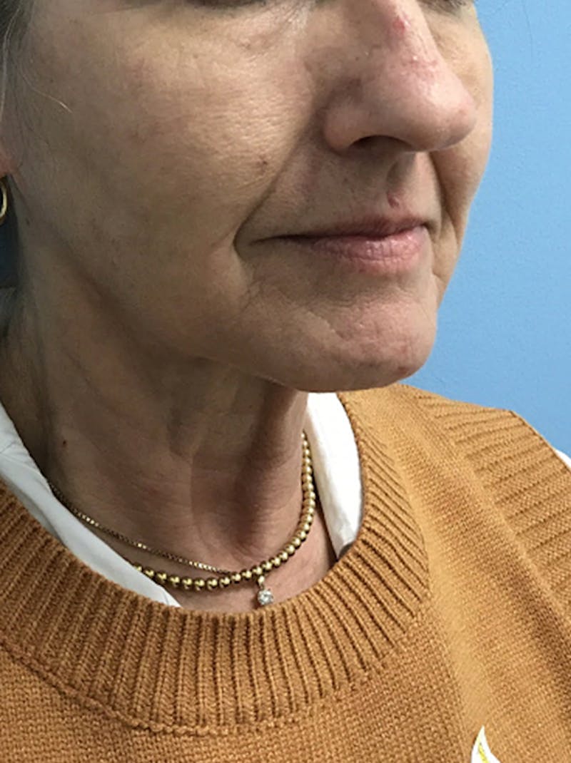 Facelift Before & After Gallery - Patient 120905405 - Image 3