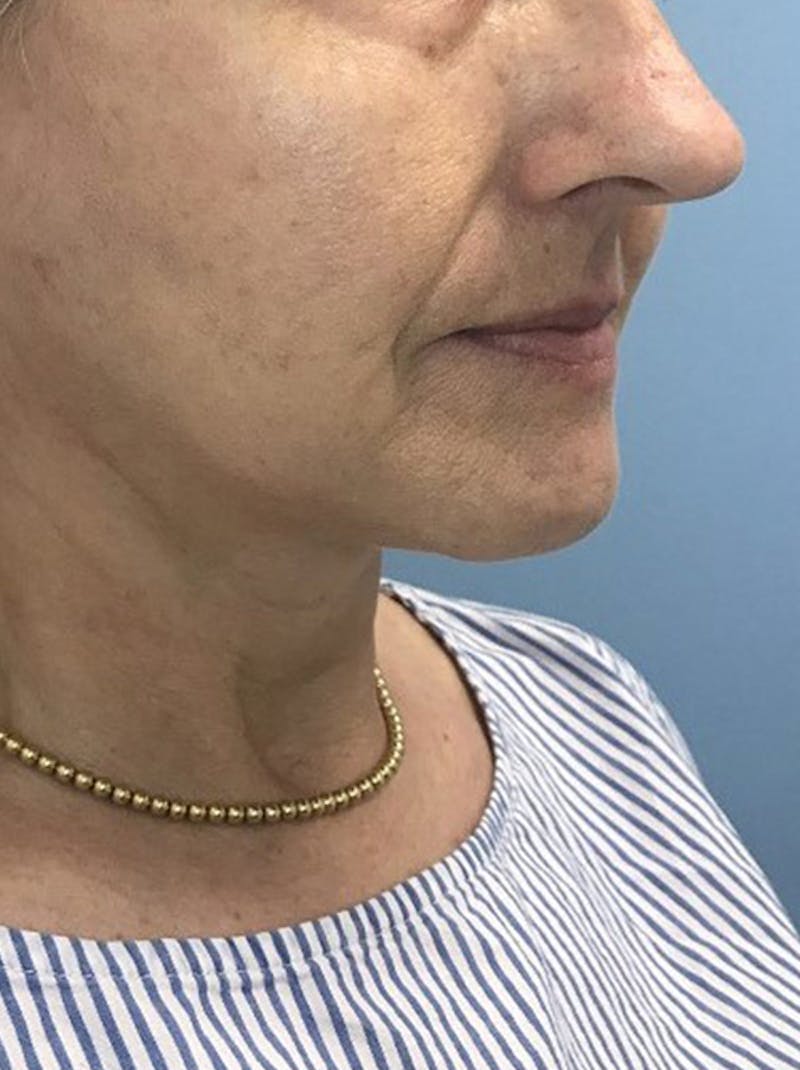 Facelift Before & After Gallery - Patient 120905405 - Image 4