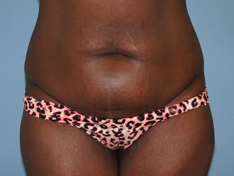 Tummy Tuck Before & After Gallery - Patient 120905417 - Image 1