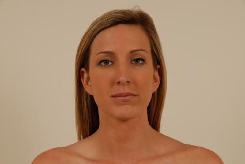 Rhinoplasty Before & After Gallery - Patient 120905420 - Image 2