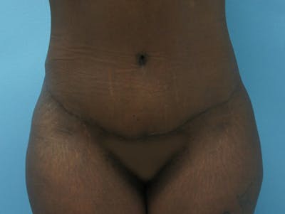 Tummy Tuck Gallery - Patient 120905417 - Image 2