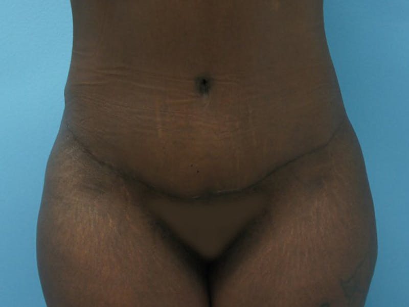 Tummy Tuck Before & After Gallery - Patient 120905417 - Image 2