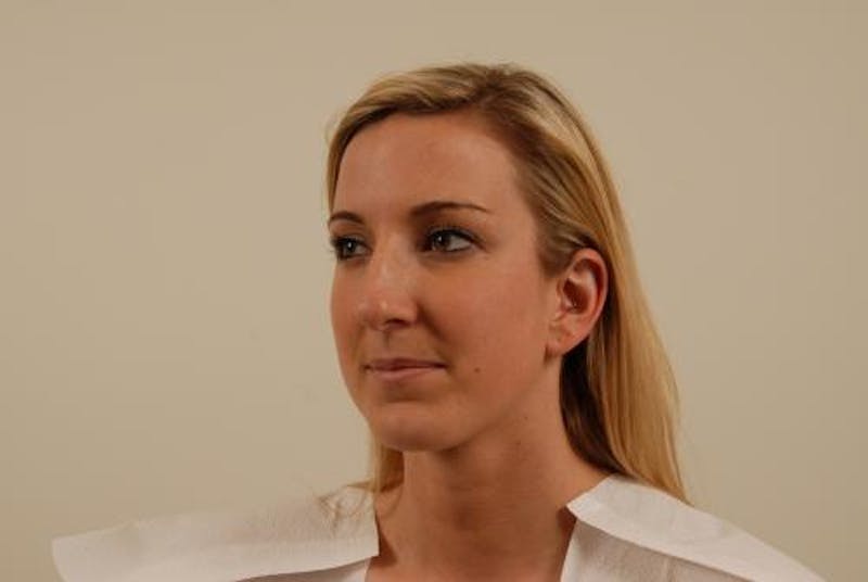 Rhinoplasty Before & After Gallery - Patient 120905420 - Image 3