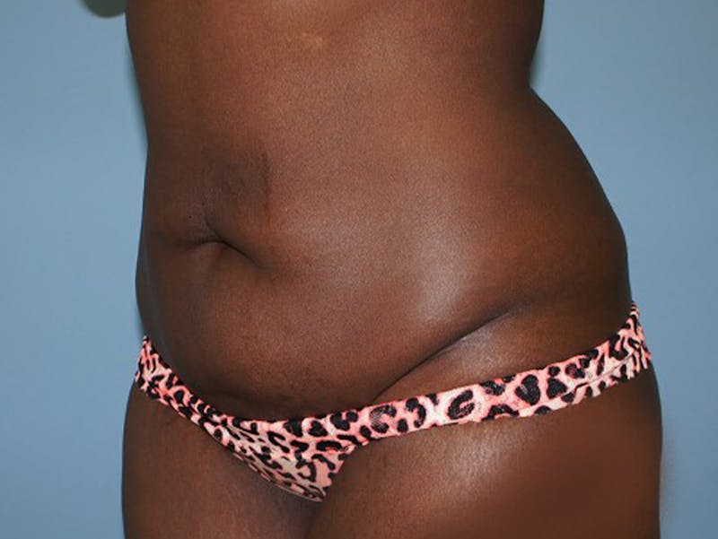 Tummy Tuck Gallery - Patient 120905417 - Image 3