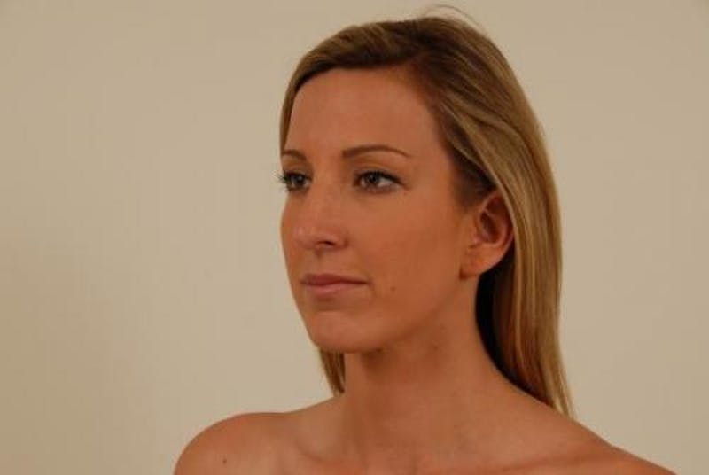 Rhinoplasty Before & After Gallery - Patient 120905420 - Image 4