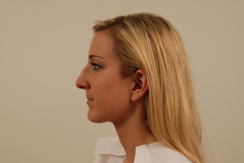 Rhinoplasty Before & After Gallery - Patient 120905420 - Image 5