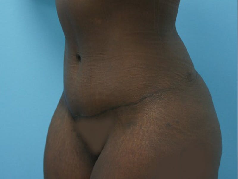 Tummy Tuck Before & After Gallery - Patient 120905417 - Image 4