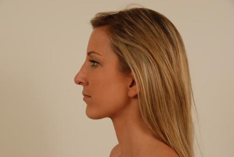 Rhinoplasty Before & After Gallery - Patient 120905420 - Image 6
