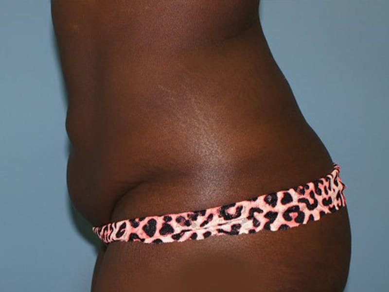Tummy Tuck Before & After Gallery - Patient 120905417 - Image 5