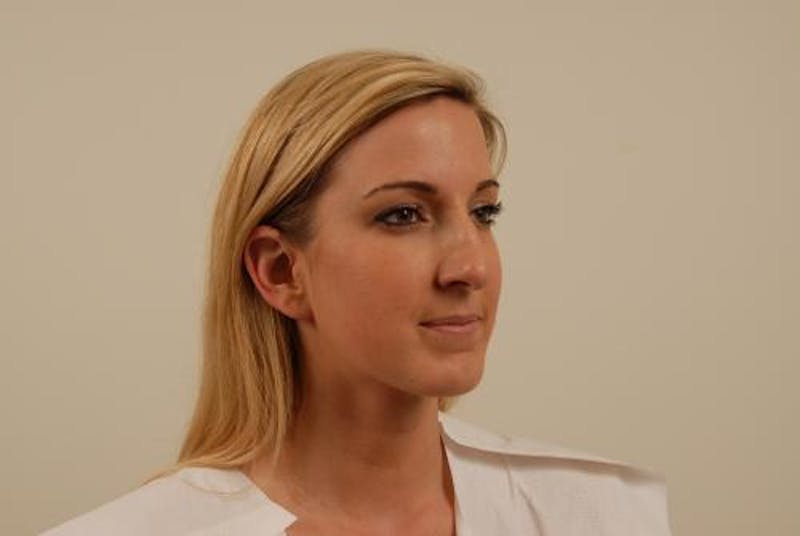 Rhinoplasty Before & After Gallery - Patient 120905420 - Image 7