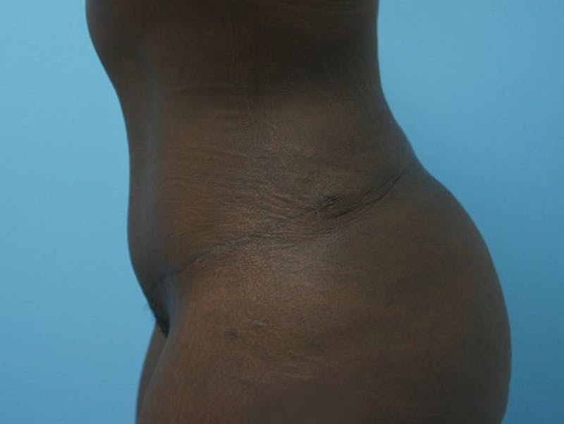 Tummy Tuck Gallery - Patient 120905417 - Image 6