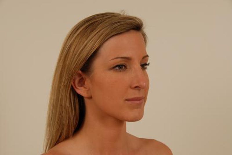 Rhinoplasty Before & After Gallery - Patient 120905420 - Image 8
