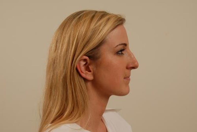 Rhinoplasty Before & After Gallery - Patient 120905420 - Image 9