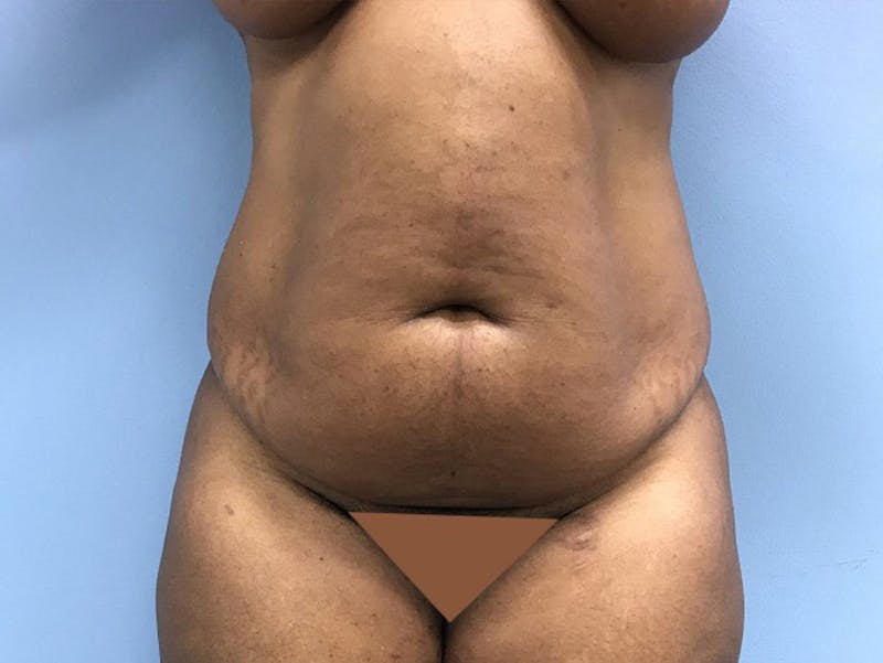 Tummy Tuck Before & After Gallery - Patient 120905428 - Image 1