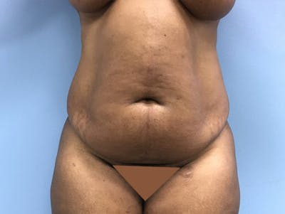 Tummy Tuck Gallery - Patient 120905428 - Image 1