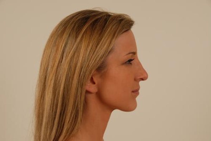 Rhinoplasty Before & After Gallery - Patient 120905420 - Image 10