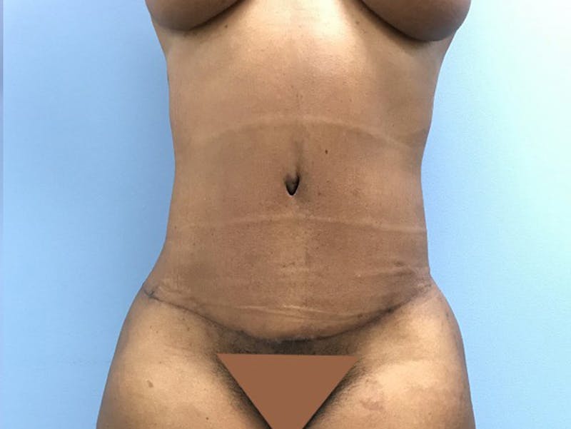 Tummy Tuck Gallery - Patient 120905428 - Image 2