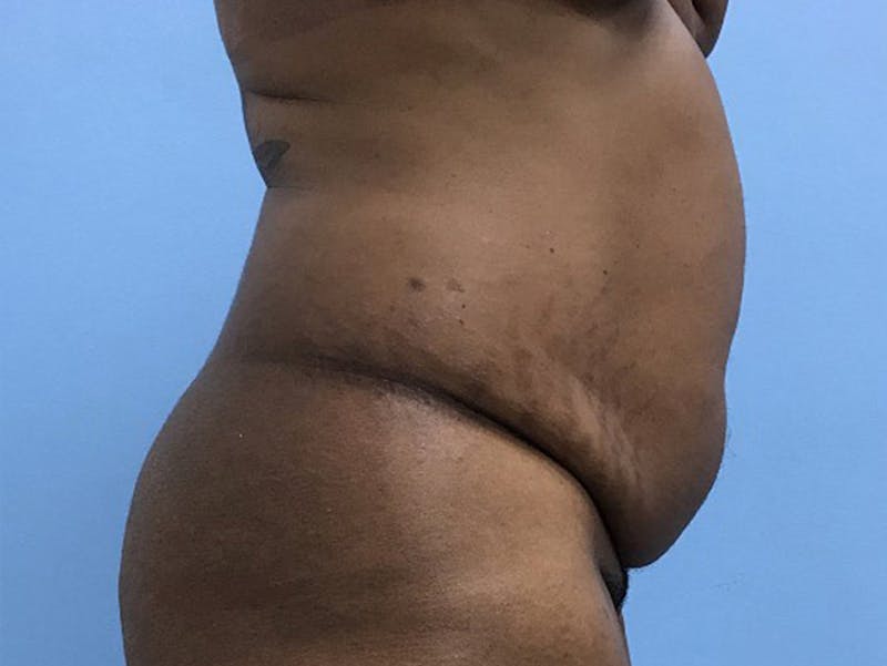Tummy Tuck Before & After Gallery - Patient 120905428 - Image 3