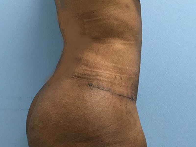 Tummy Tuck Before & After Gallery - Patient 120905428 - Image 4
