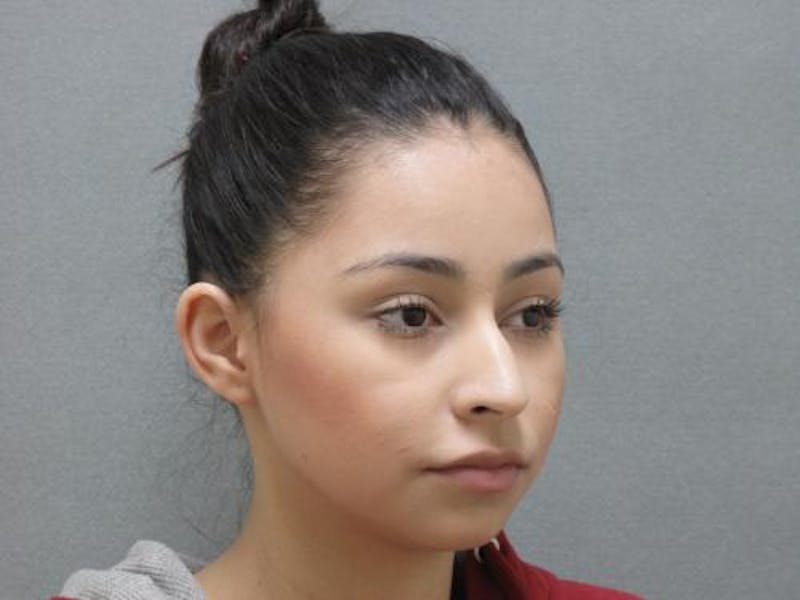 Rhinoplasty Before & After Gallery - Patient 120905429 - Image 3