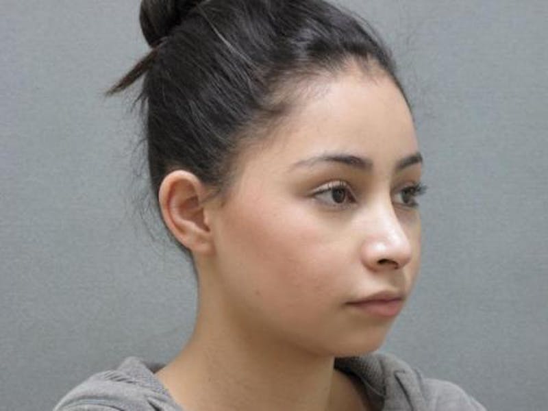 Rhinoplasty Before & After Gallery - Patient 120905429 - Image 4