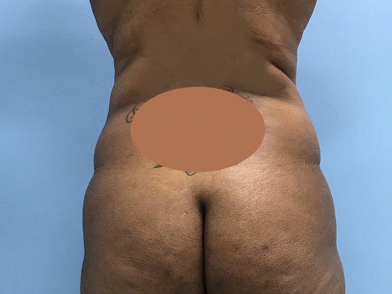 Tummy Tuck Before & After Gallery - Patient 120905428 - Image 5