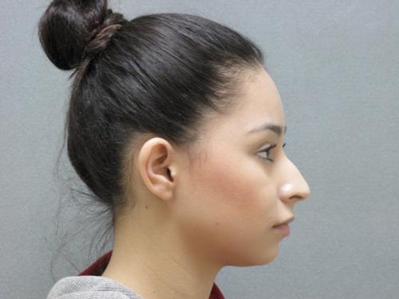 Rhinoplasty Before & After Gallery - Patient 120905429 - Image 5