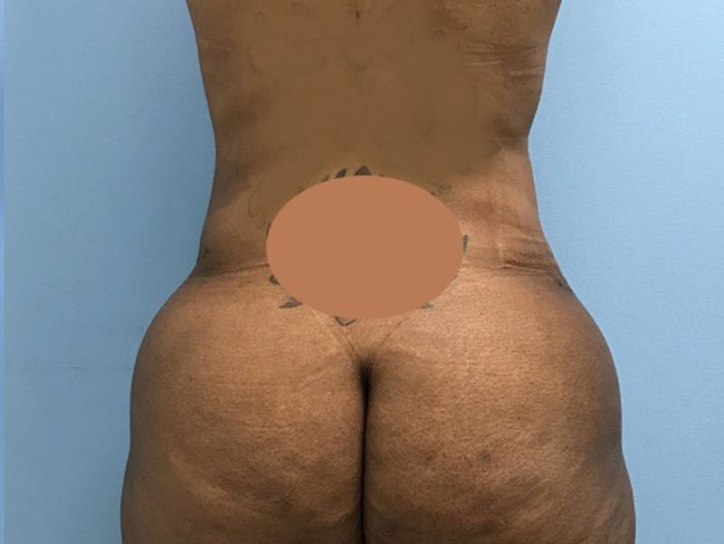 Tummy Tuck Before & After Gallery - Patient 120905428 - Image 6