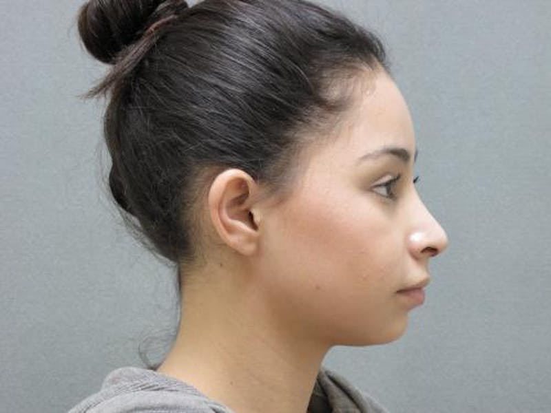 Rhinoplasty Before & After Gallery - Patient 120905429 - Image 6