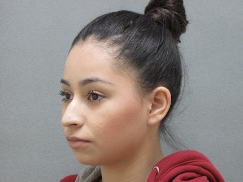 Rhinoplasty Before & After Gallery - Patient 120905429 - Image 7