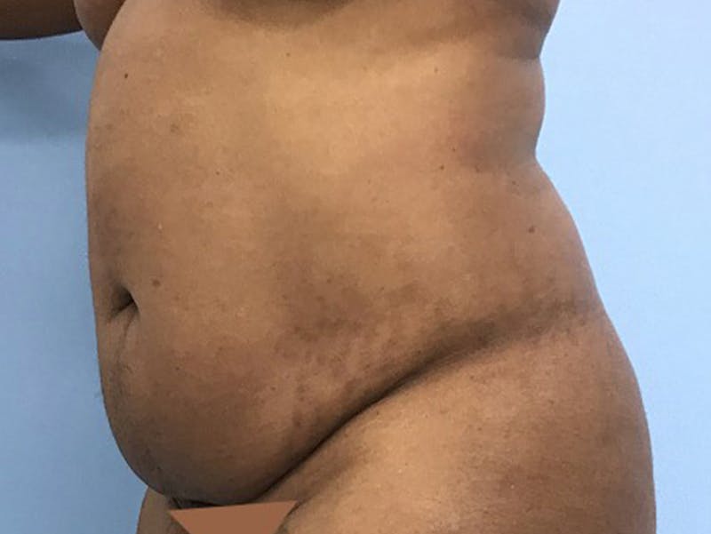 Tummy Tuck Before & After Gallery - Patient 120905428 - Image 7