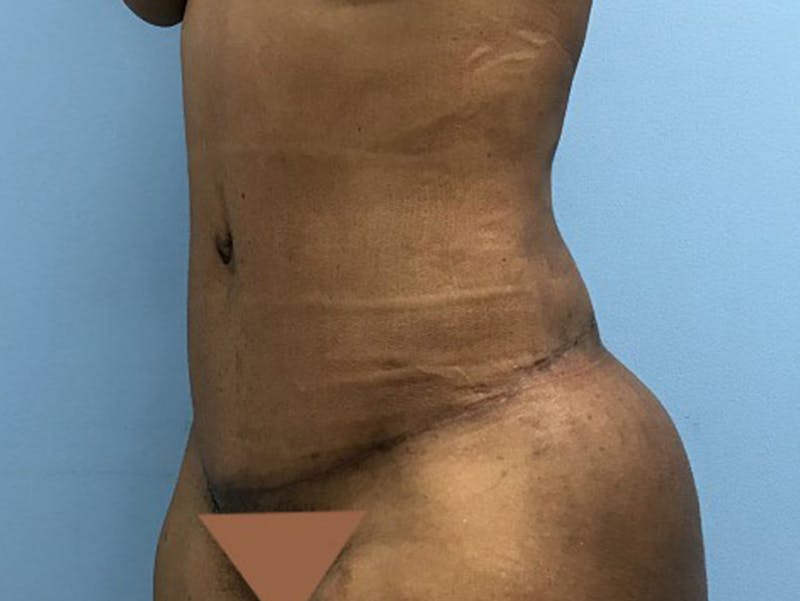 Tummy Tuck Before & After Gallery - Patient 120905428 - Image 8
