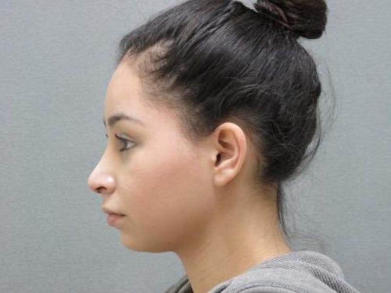 Rhinoplasty Before & After Gallery - Patient 120905429 - Image 9