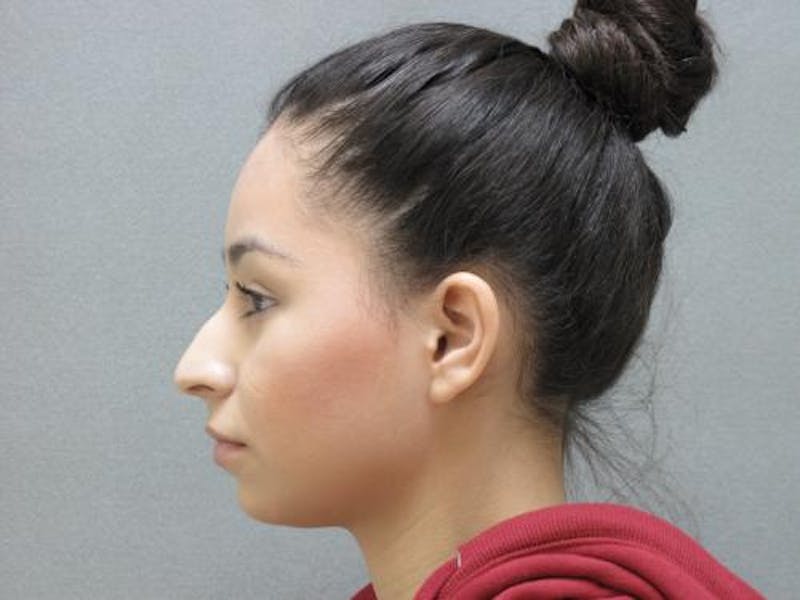 Rhinoplasty Before & After Gallery - Patient 120905429 - Image 10