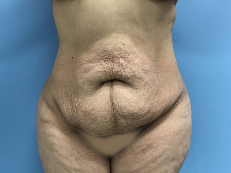 Tummy Tuck Before & After Gallery - Patient 120905446 - Image 1