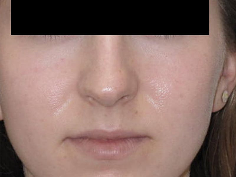 Rhinoplasty Before & After Gallery - Patient 120905445 - Image 1