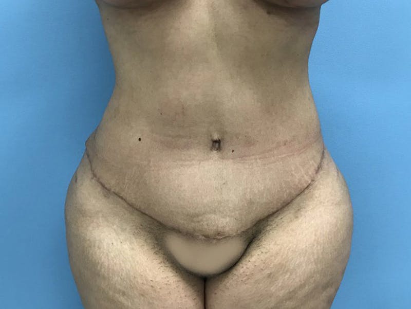 Tummy Tuck Before & After Gallery - Patient 120905446 - Image 2