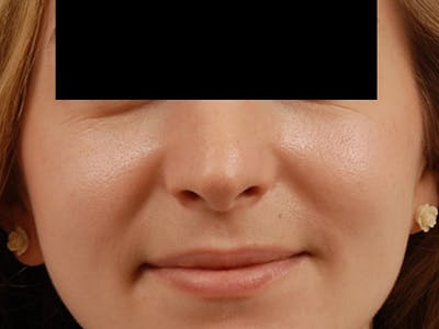 Rhinoplasty Before & After Gallery - Patient 120905445 - Image 2