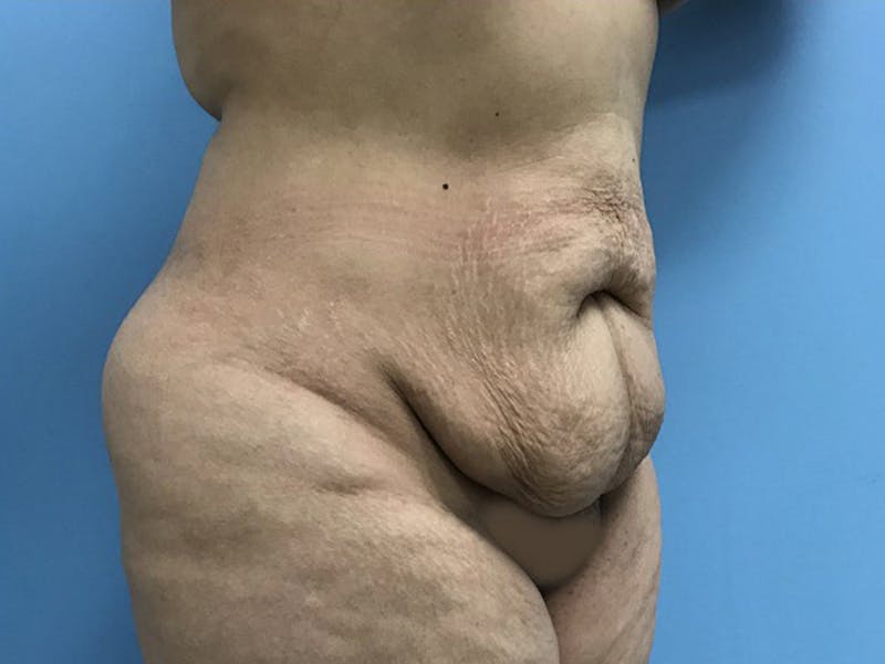 Tummy Tuck Before & After Gallery - Patient 120905446 - Image 3