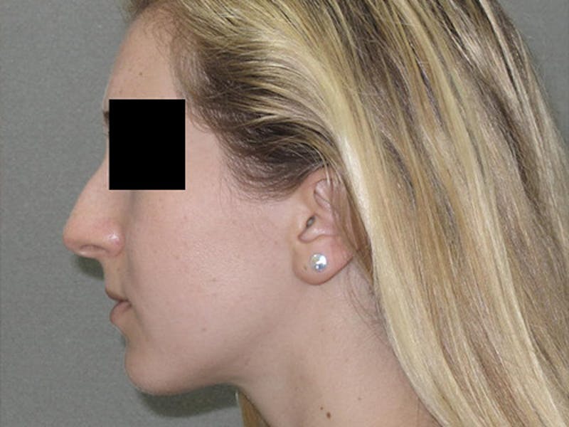 Rhinoplasty Before & After Gallery - Patient 120905445 - Image 3