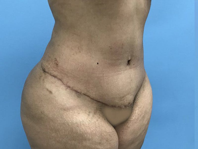Tummy Tuck Before & After Gallery - Patient 120905446 - Image 4