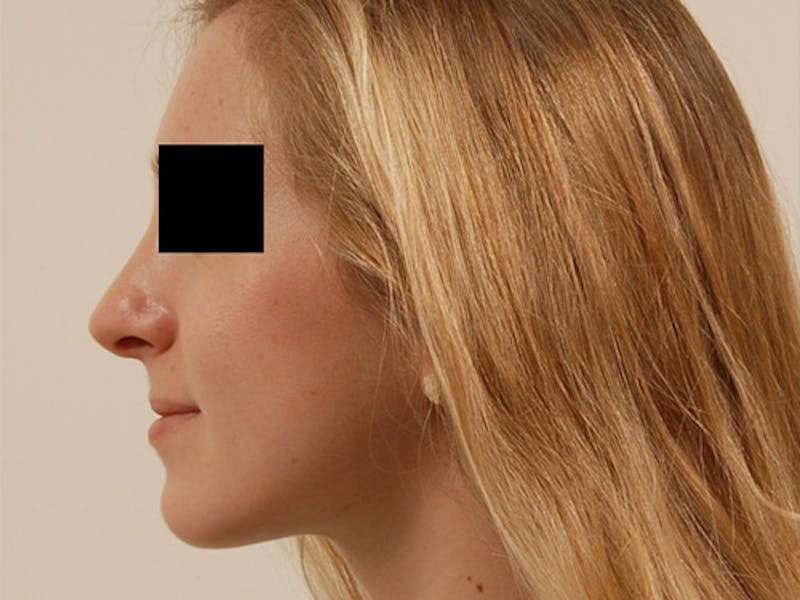 Rhinoplasty Before & After Gallery - Patient 120905445 - Image 4