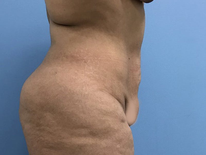 Tummy Tuck Before & After Gallery - Patient 120905446 - Image 5