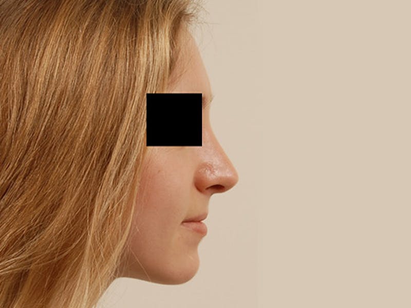 Rhinoplasty Before & After Gallery - Patient 120905445 - Image 6