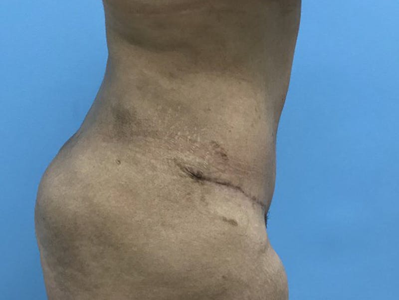 Tummy Tuck Before & After Gallery - Patient 120905446 - Image 6