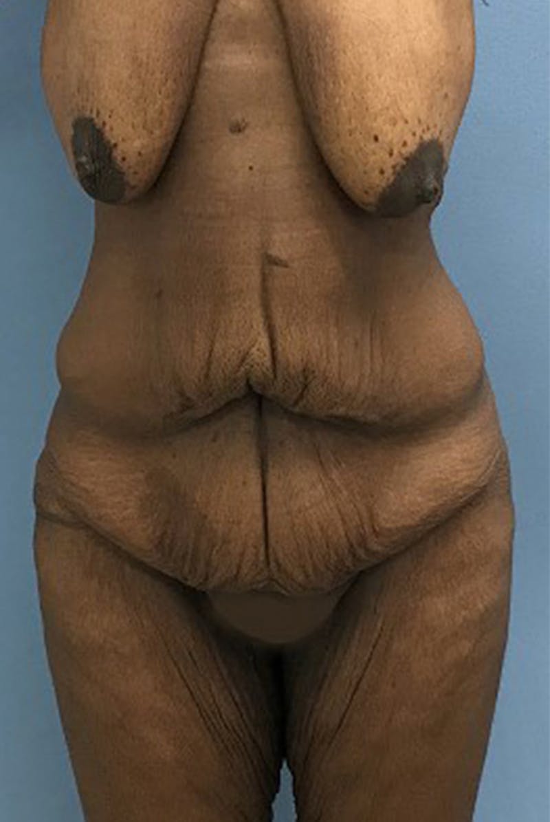 Tummy Tuck Before & After Gallery - Patient 120905450 - Image 1
