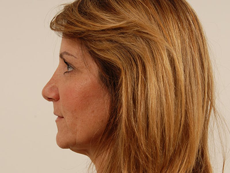 Rhinoplasty Before & After Gallery - Patient 120905451 - Image 4