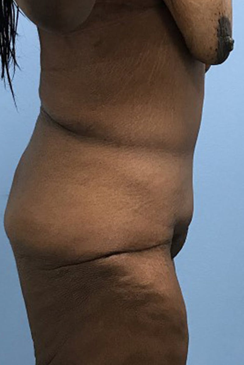 Tummy Tuck Before & After Gallery - Patient 120905450 - Image 4