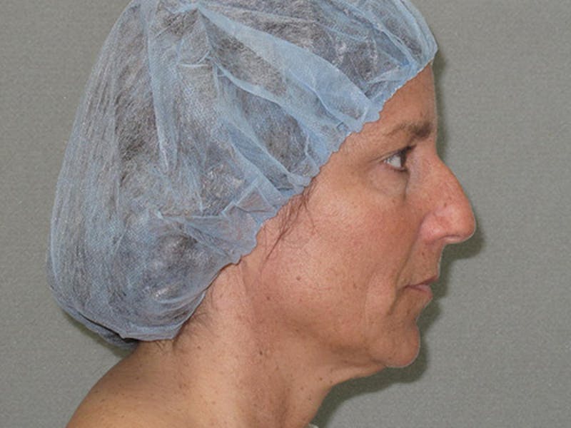 Rhinoplasty Before & After Gallery - Patient 120905451 - Image 5